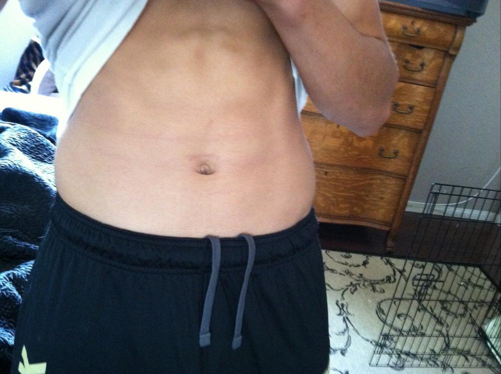 Did I just give myself stretch marks on my abs? (pics) - Bodybuilding ...